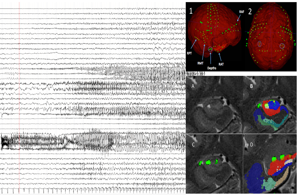 Intracranial EEG data from subject with non-lesional right temporal lobe epilepsy